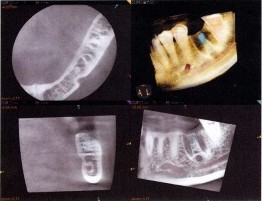 implant-before